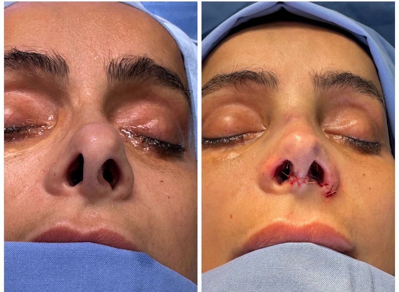 Primary Rhinoplasty