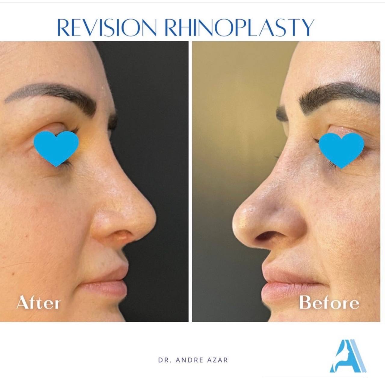 Rhinoplasty Revision: Discover the Benefits and Process for a Perfect Outcome 2025