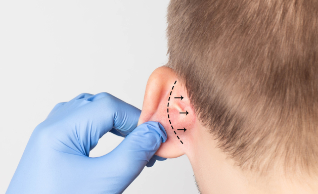 A Comprehensive Guide to Otoplasty (Ear Reshaping Surgery) 2025