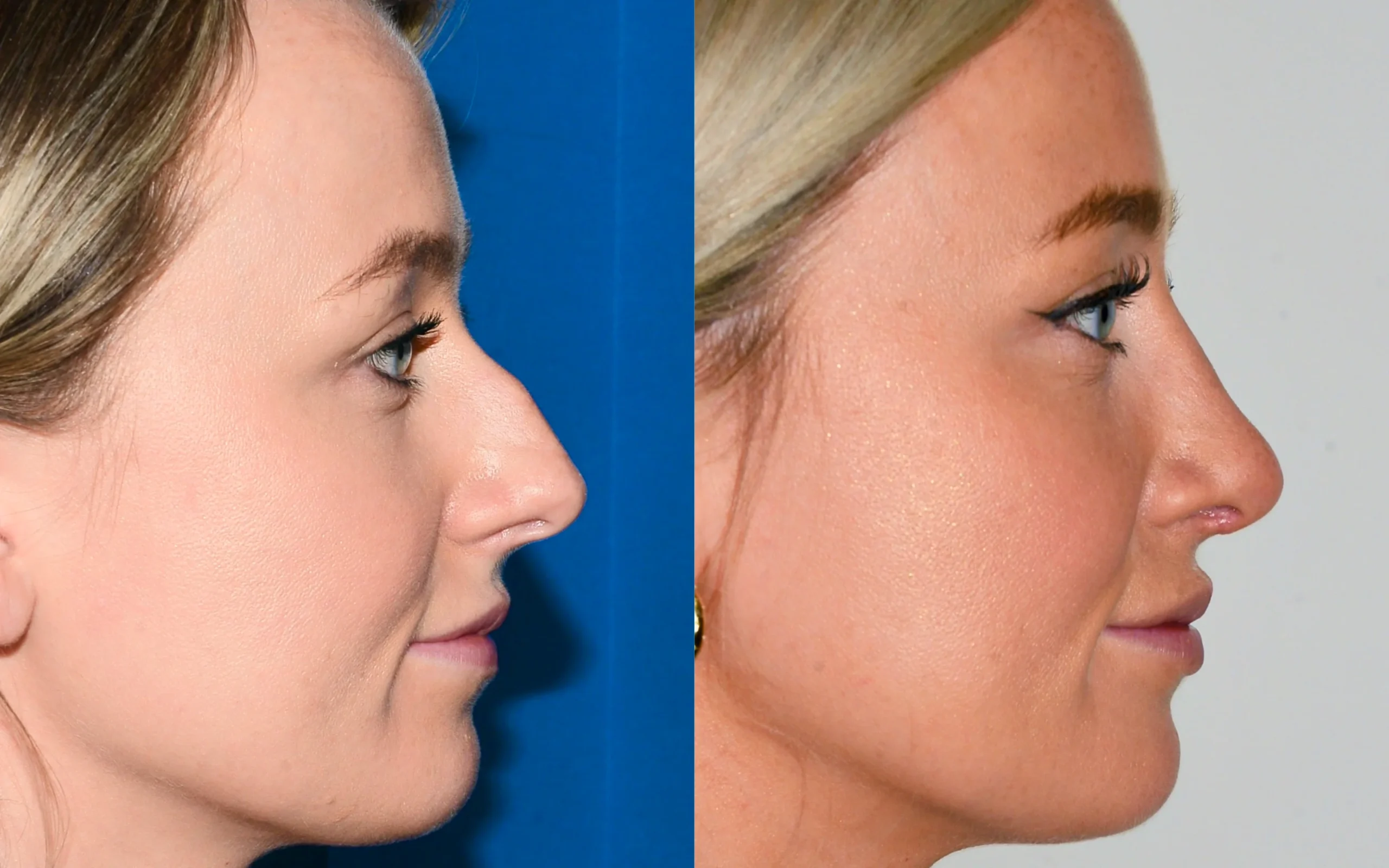 Rhinoplasty Perfection: Discover the Life-Changing Power of Nose Surgery 2025