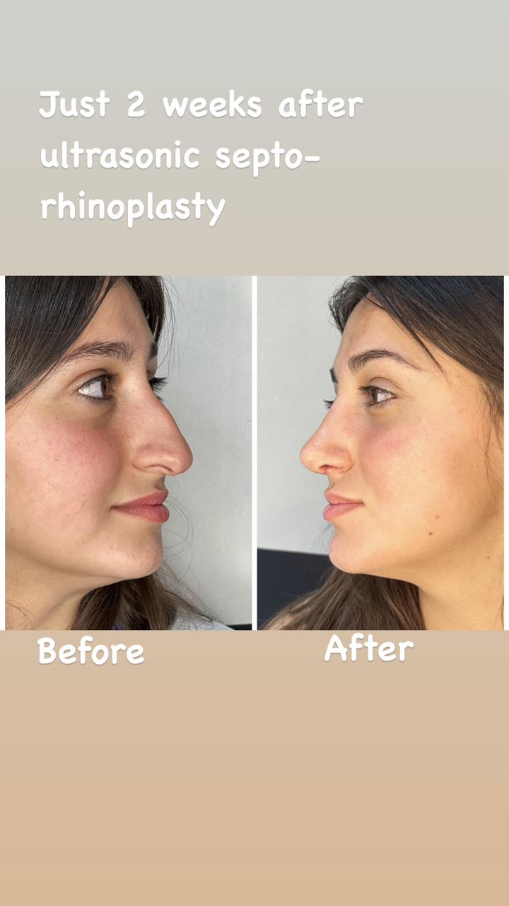 Best Rhinoplasty Surgeon