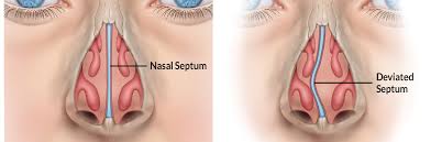 Functional Rhinoplasty