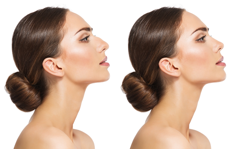 Ultrasonic Rhinoplasty