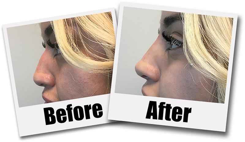 Non-Surgical Rhinoplasty
