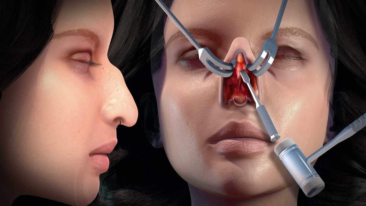 Rhinoplasty Lebanon